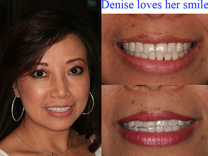 Invisalign treatment