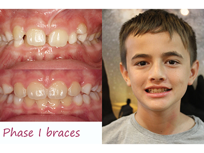 Metal Braces