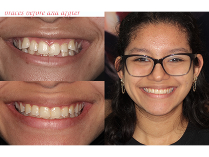 Metal Braces