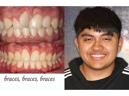 Metal Braces