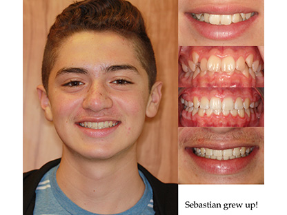 Metal Braces