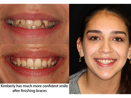 Metal Braces