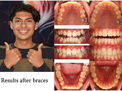 Metal Braces