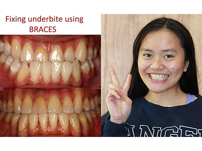Metal Braces
