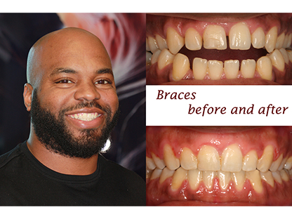 Metal Braces