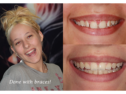 Metal Braces