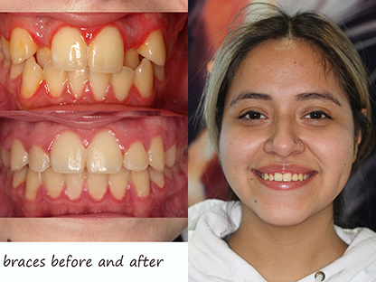 Metal Braces