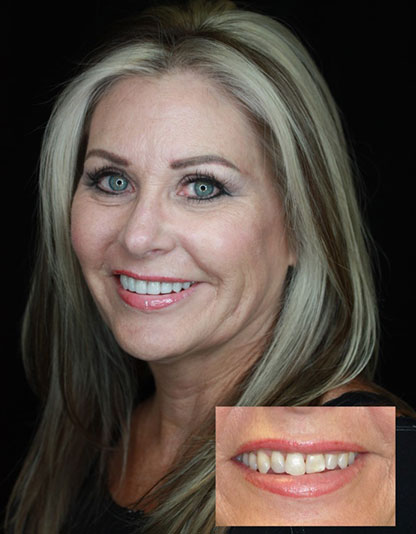 Porcelain Veneers