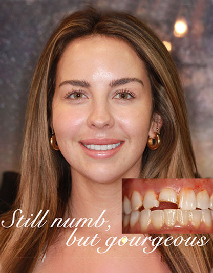 Porcelain Veneers