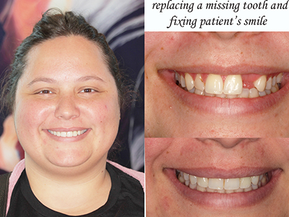 Same Day Dental Implant