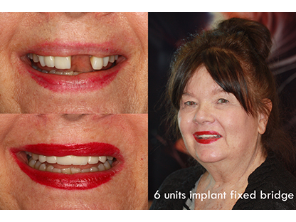 Same Day Dental Implant