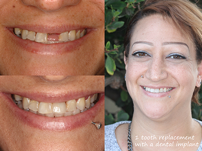 Same Day Dental Implant