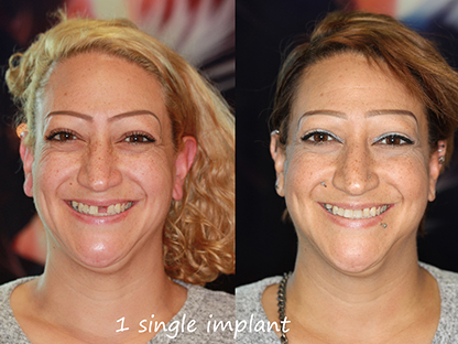 Same Day Dental Implant