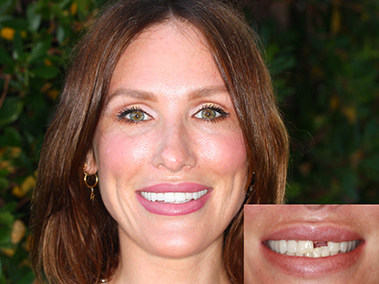 Same Day Dental Implant