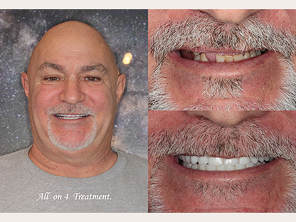 All One 4 Implant