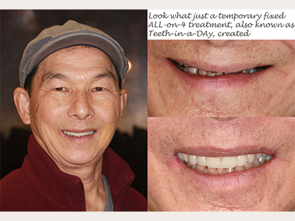 All One 4 Implant