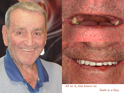 All One 4 Implant