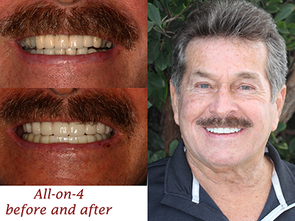 All One 4 Implant