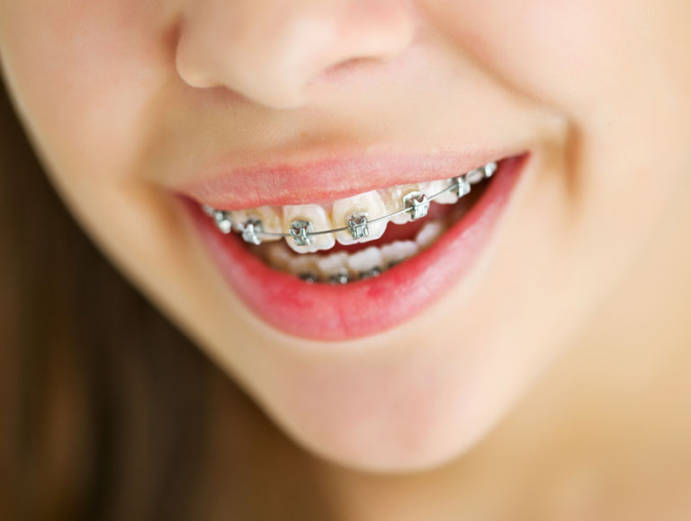 Children orthodontics in Fountain Valley, California