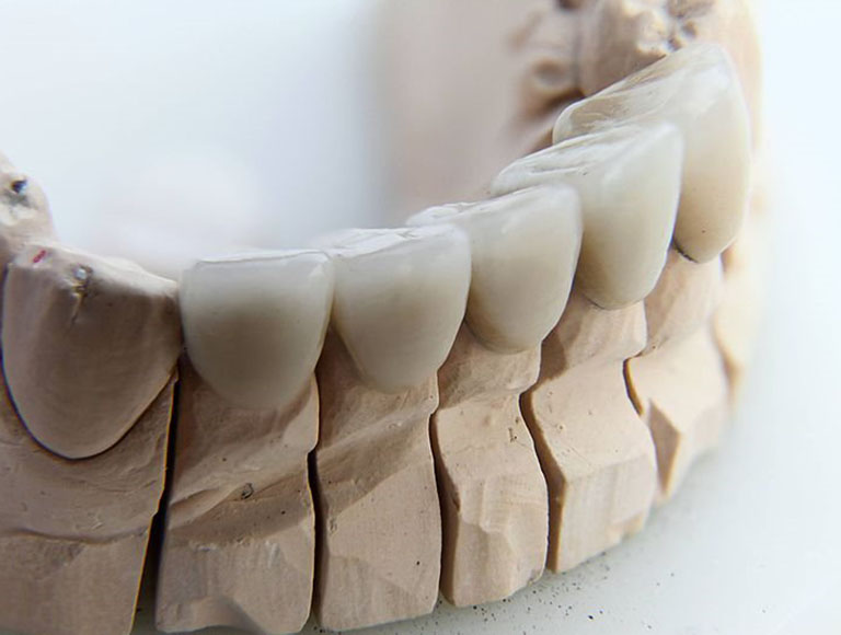 Dental Crown