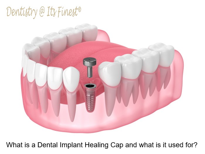 Dental Implant Healing Cap and what is it used-for
