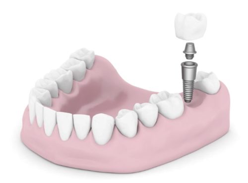 /wp-content/uploads/2025/06/Dental-Implants-img.jpg