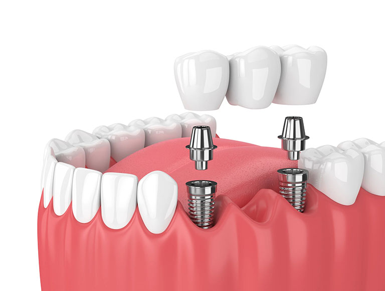 Dental bridges – Orange County