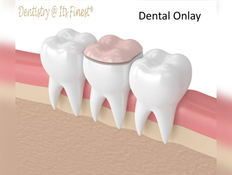 Dental onlays