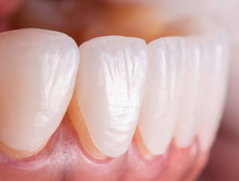 Dental veneer – Irvine