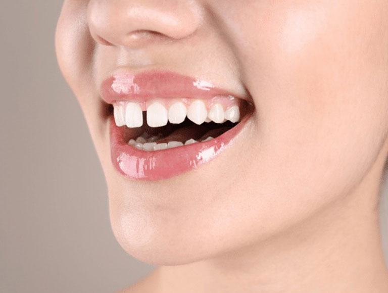 What Causes Gaps Between Teeth?