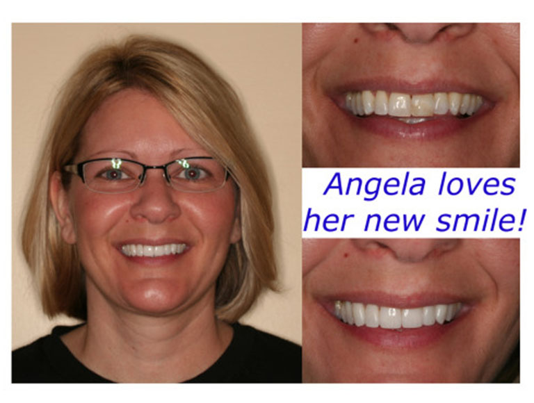 Dental Veneers for Irvine