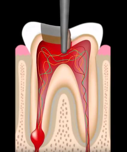 Removing The Infection
