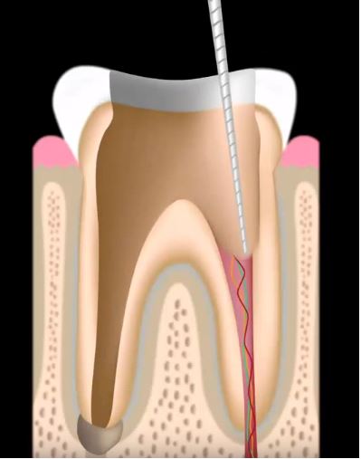 Removing the Dead Nerves