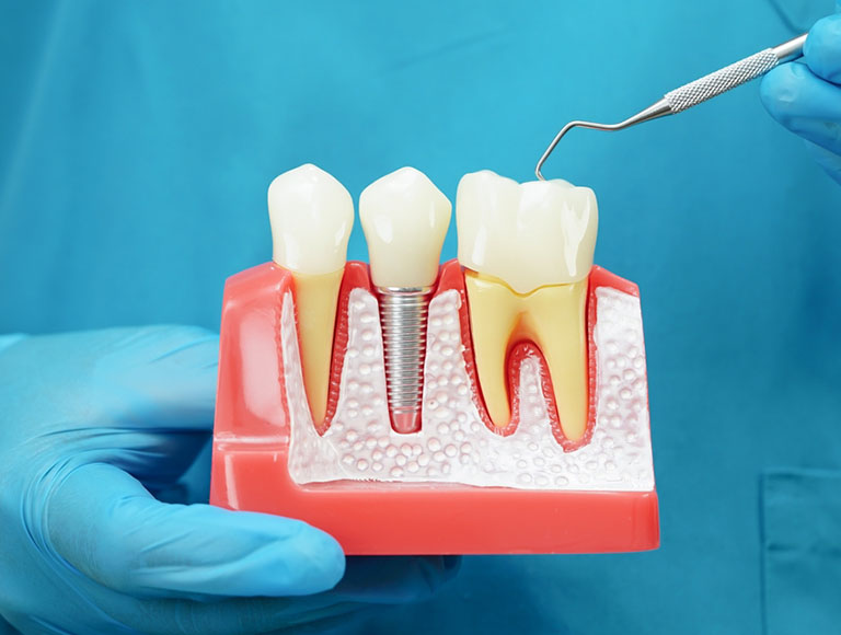 Root Canal Aftercare