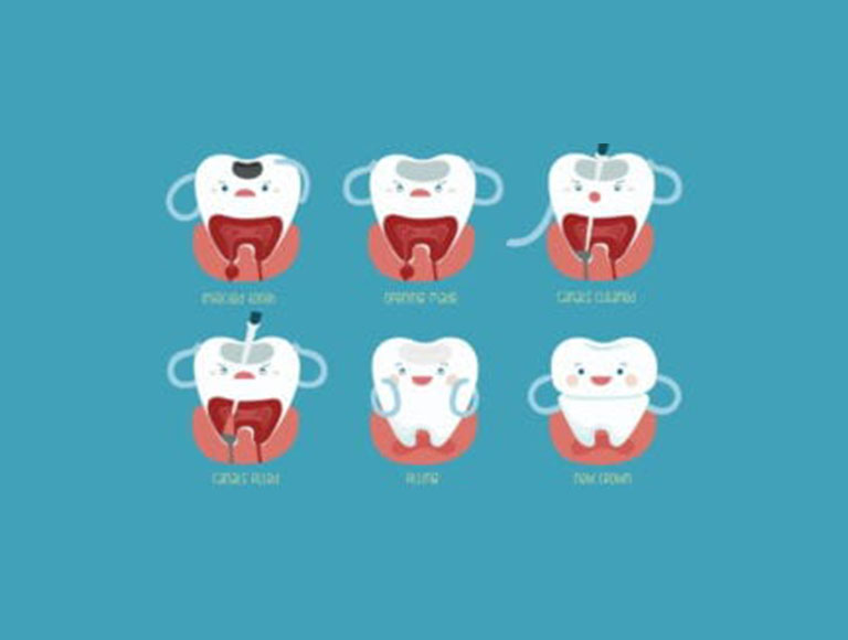 Root Canals in Costa Mesa