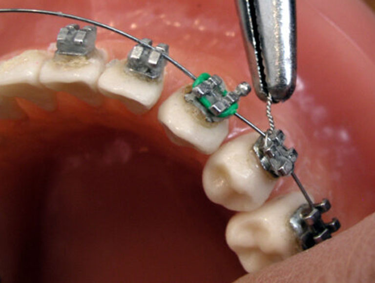 Teens Bite Alignement