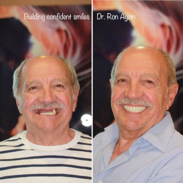 All on X dental implants