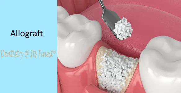 Allograft