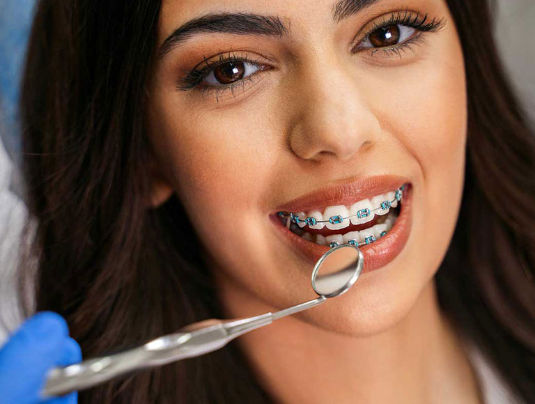 Ceramic bracket braces for Adults