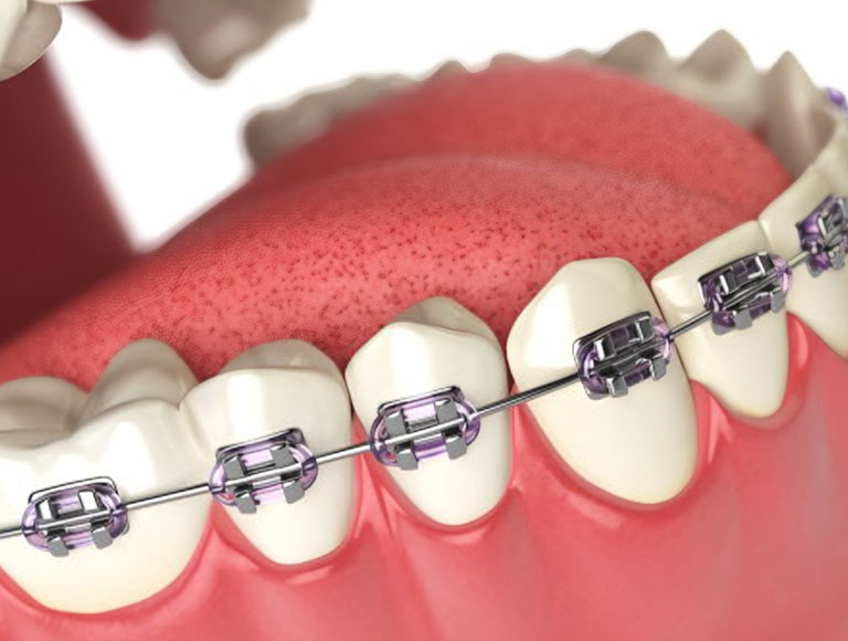 Metal Braces Cost