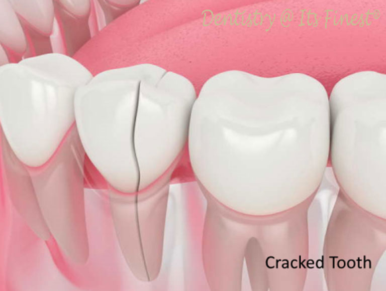 A cracked or broken tooth