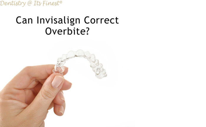 Can Invisalign Coorect Overbite