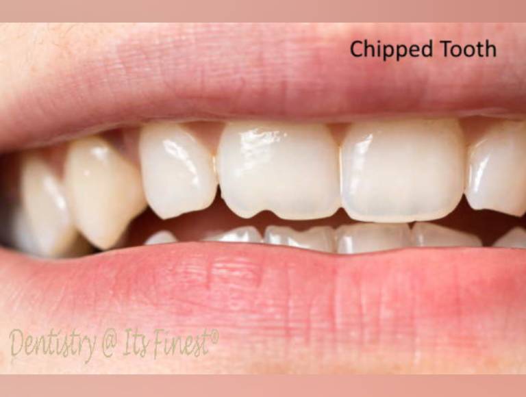 Chipped Teeth