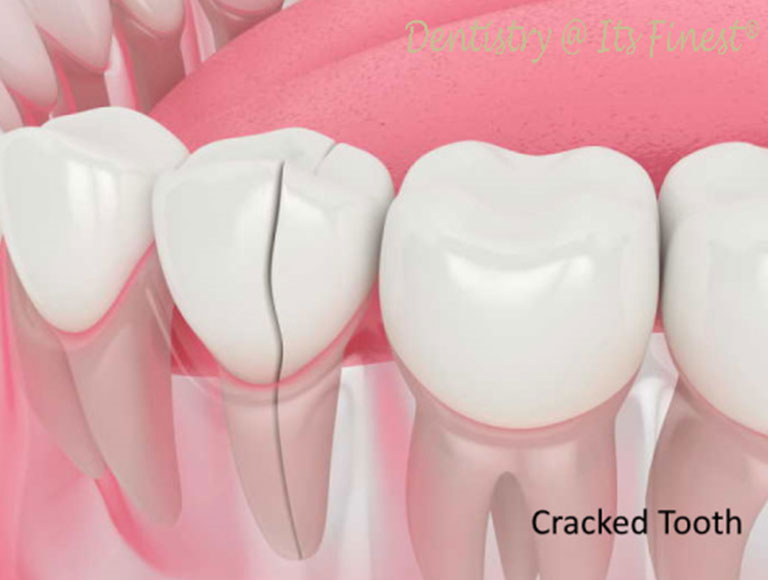 Emergency broken tooth repair in Costa Mesa