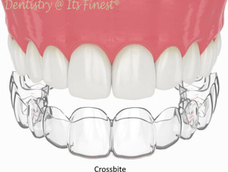 What Causes Crossbite?