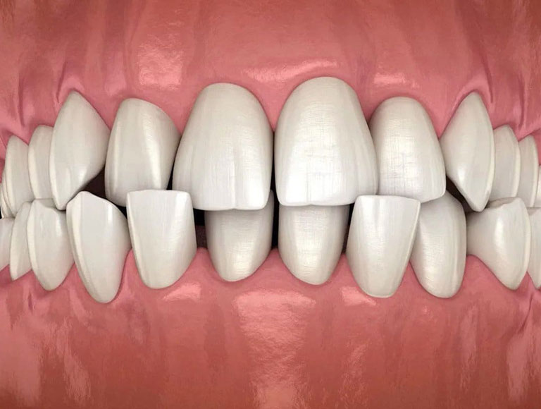 Crossbite Vs Underbite