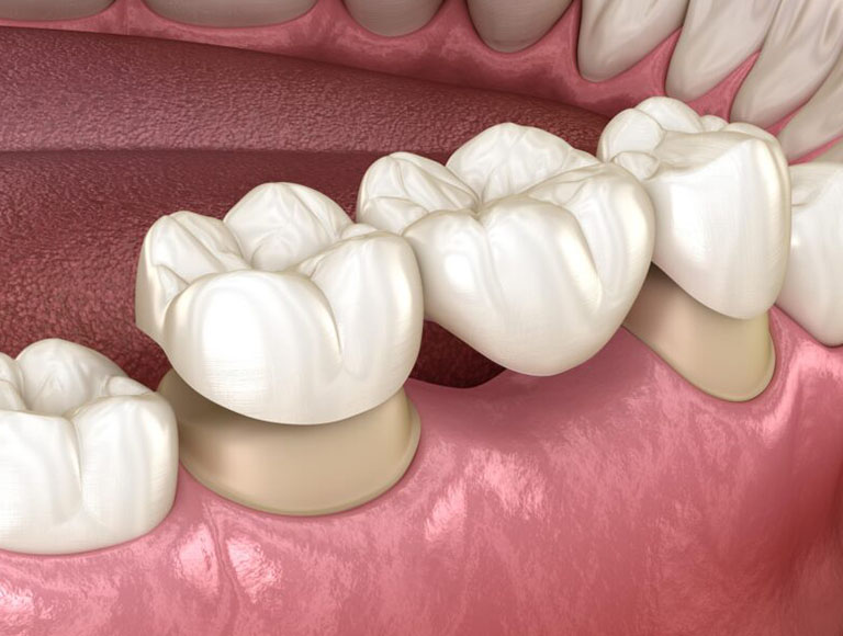 Dental bridge cost