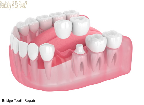 Dental bridges repair