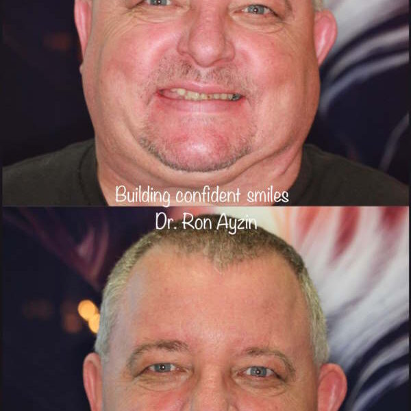 Dental implant Before And After