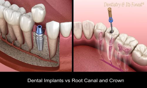 Dental Implants Vs Root Canal and Crown